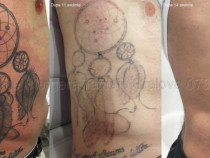 Indepartare stergere tatuaje craiova