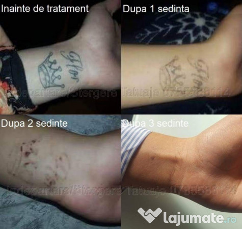 Indepartare Stergere Tatuaje Cu Laser Craiova 150 Ron Lajumatero